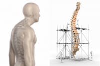 Kyphosis Posture